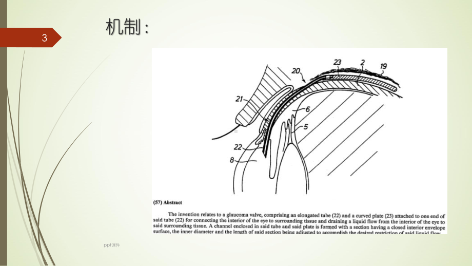 青光眼引流阀-课件.ppt_第3页