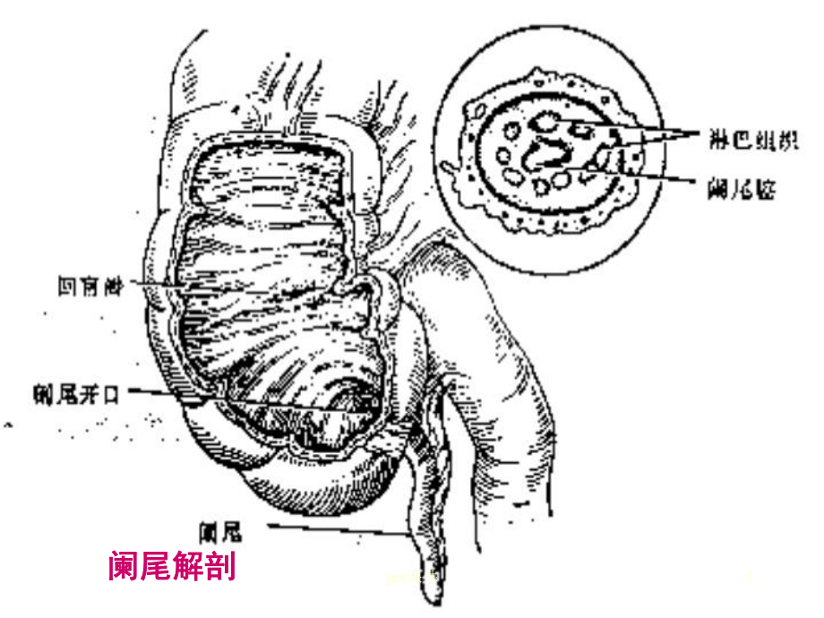 阑尾炎（普外科）-课件.ppt_第3页