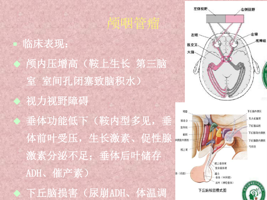 颅咽管瘤课件.pptx_第3页