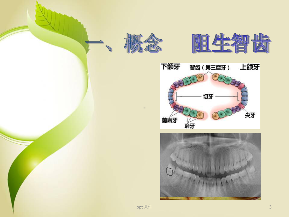 阻生智齿拔除病人的临床护理-课件.ppt_第3页