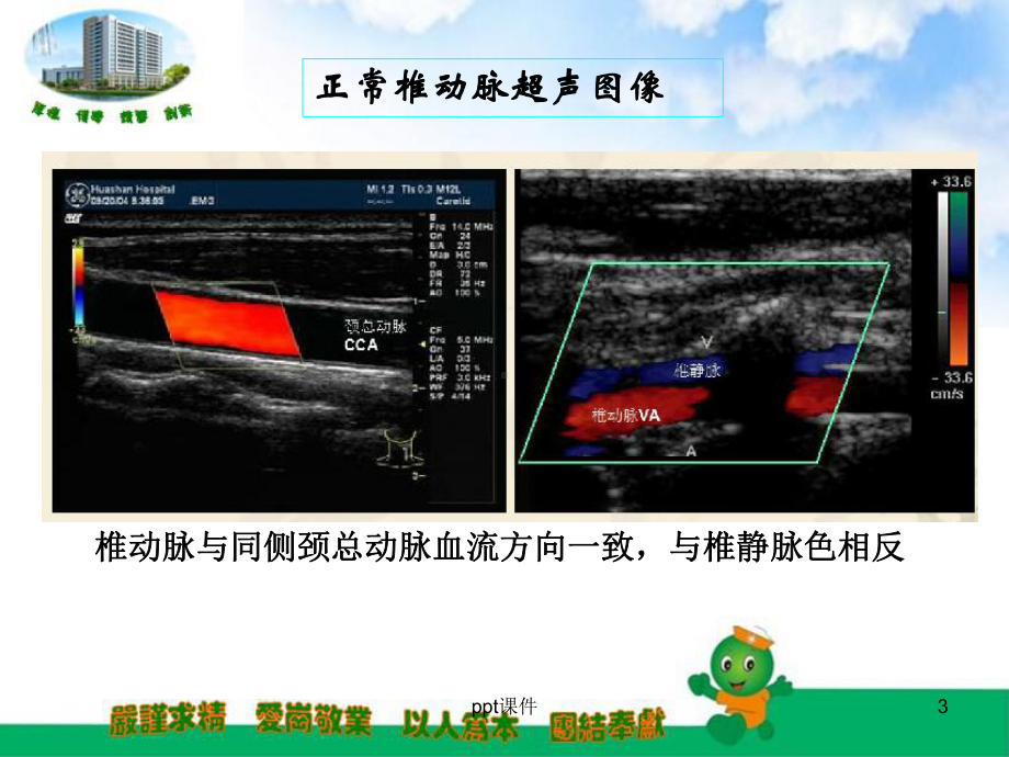 锁骨下动脉盗血综合征-课件.ppt_第3页