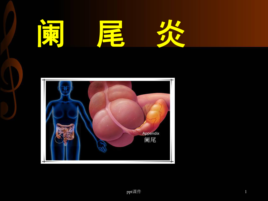 阑尾炎-课件(同名348).ppt_第1页