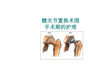 髋关节置换术围手术期的护理 .ppt