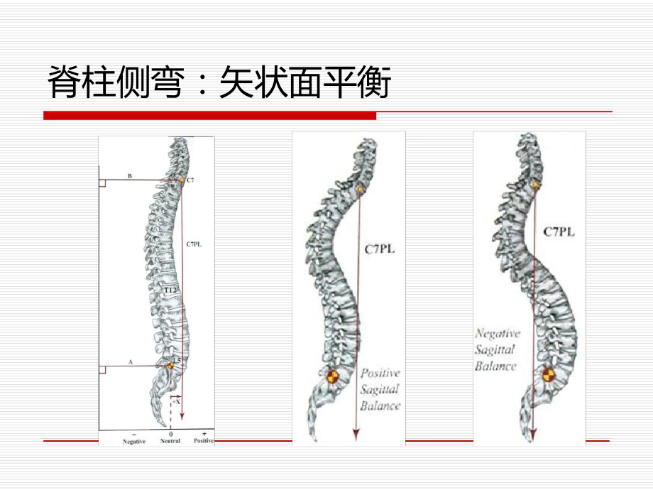 脊柱侧弯完整版最新优质课件.ppt_第3页