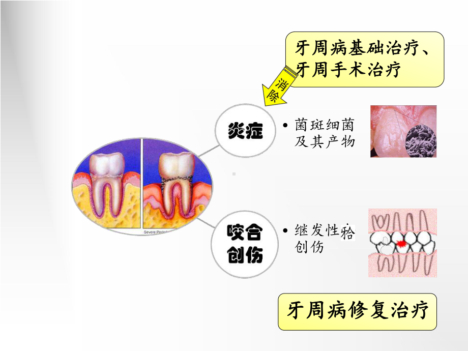 第十一章-牙周病的修复治疗课件1.ppt_第3页