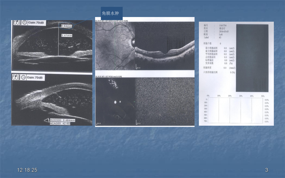 白内障眼内炎医学课件.ppt_第3页