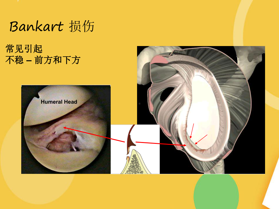 肩关节bankart损伤优品资料课件.ppt_第2页