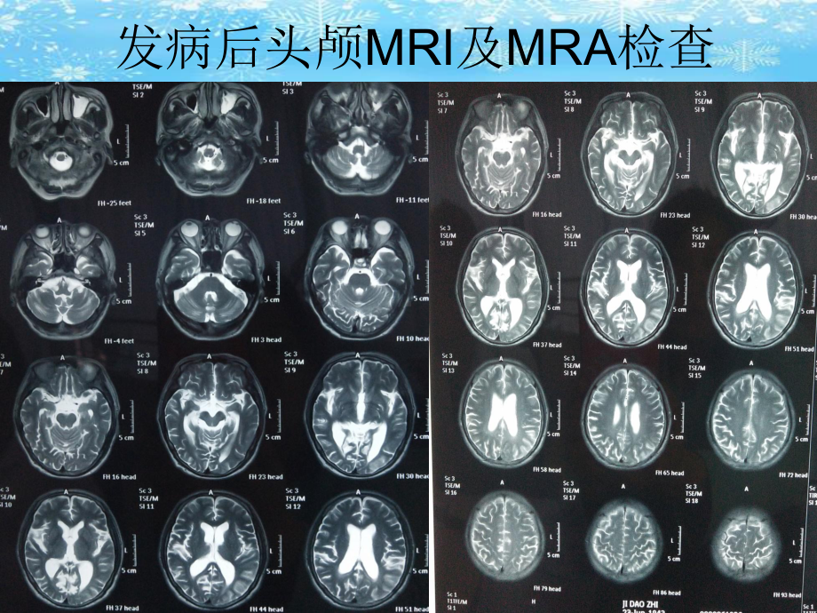 脑梗死出血性转化2021完整版课件.ppt_第3页