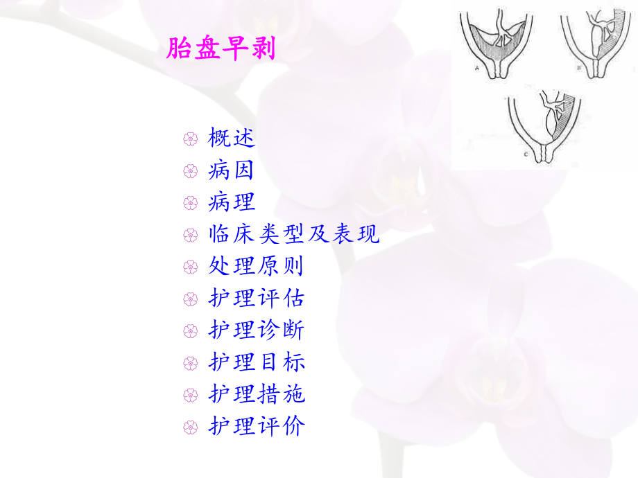 胎盘早剥护理课件.ppt_第2页