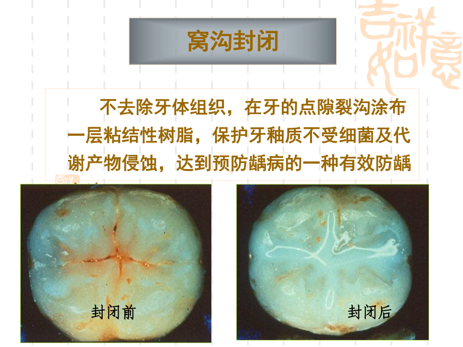 窝沟封闭宣传疾病课件.pptx_第3页