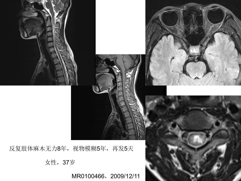 视神经脊髓炎的MR诊断课件.ppt_第1页