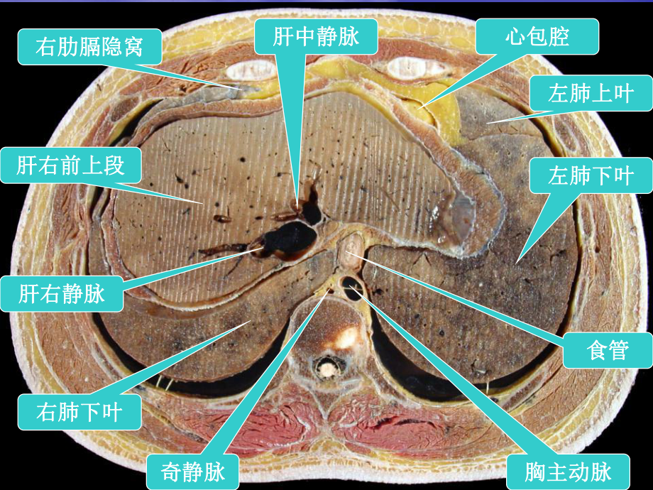 腹部的横断层解剖课件.ppt_第3页