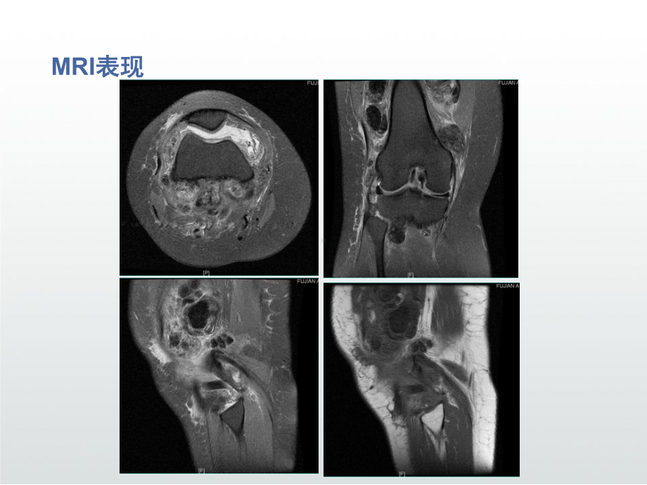 色素沉着绒毛结节性滑膜炎影像表现课件.ppt_第3页