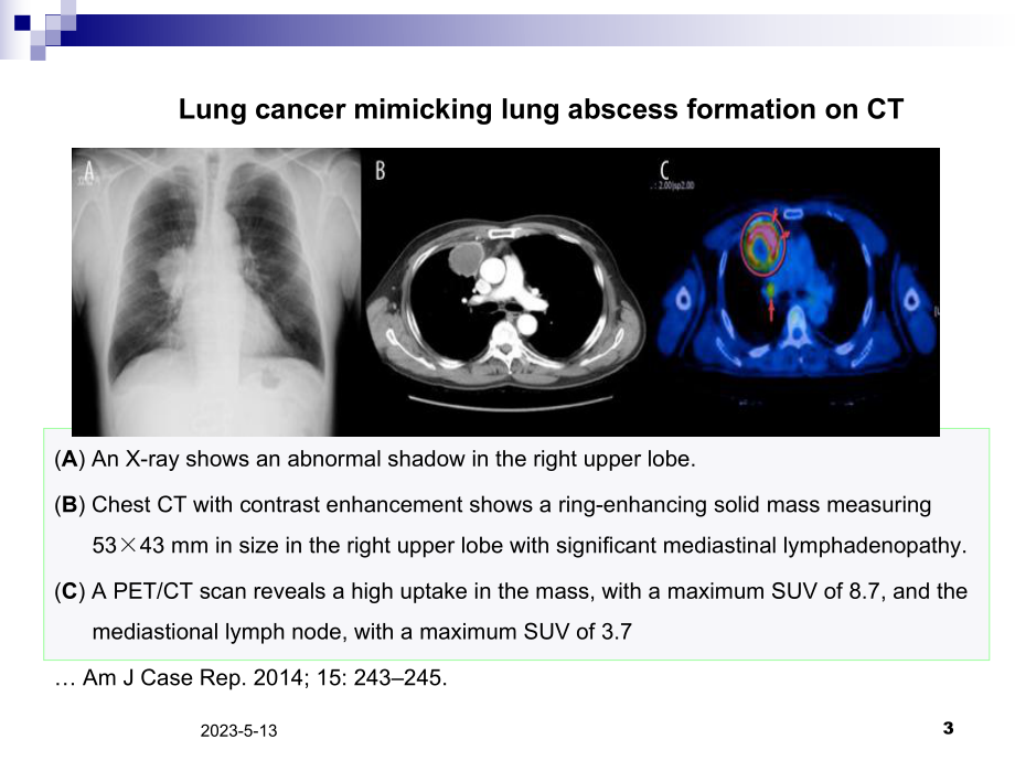 肺脓肿影像诊断课件.ppt_第3页