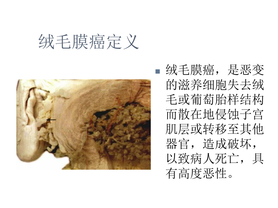 绒毛膜癌护理查房课件.pptx_第3页