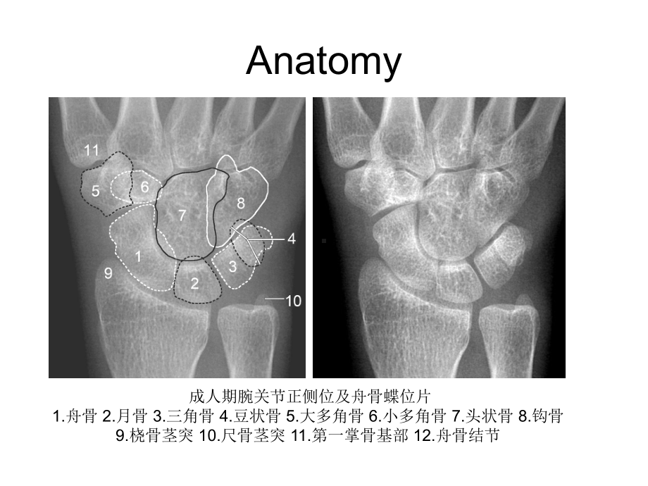 腕关节-X线解剖课件.ppt_第3页