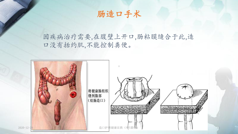 造口护理健康宣教(课件).pptx_第3页