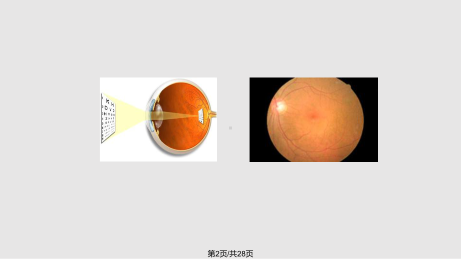 老年性黄斑变性课件.pptx_第2页