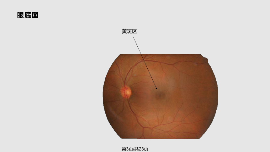 老年人常见眼病课件.pptx_第3页