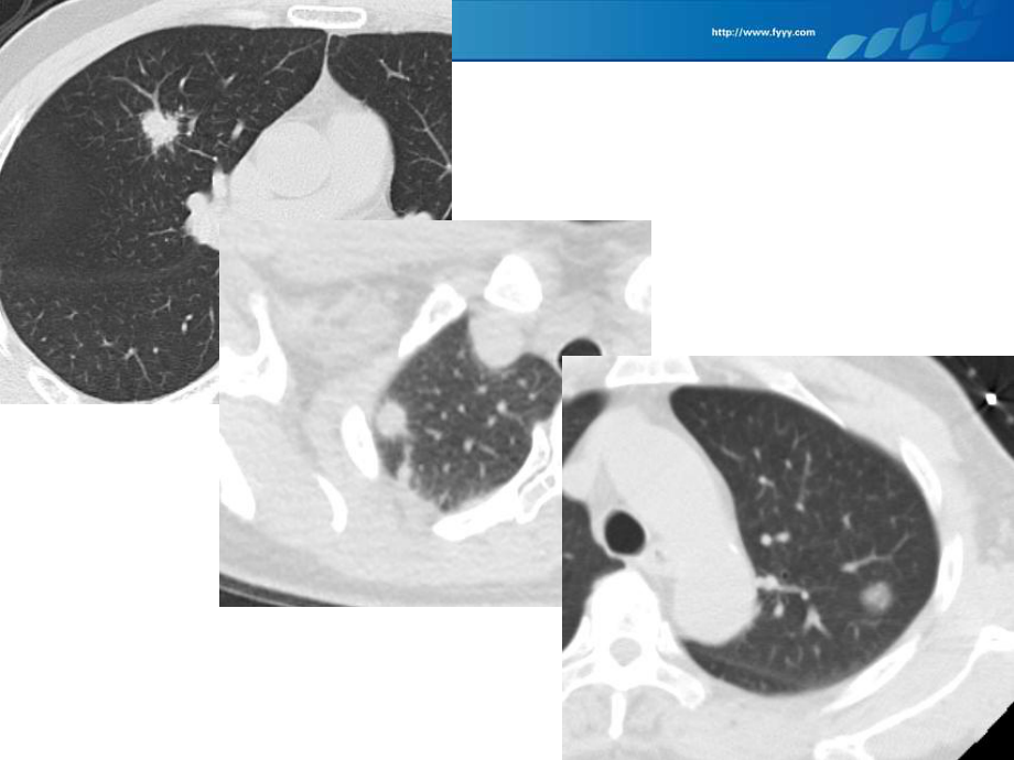 肺部结节的CT诊断及处理方案.ppt_第2页