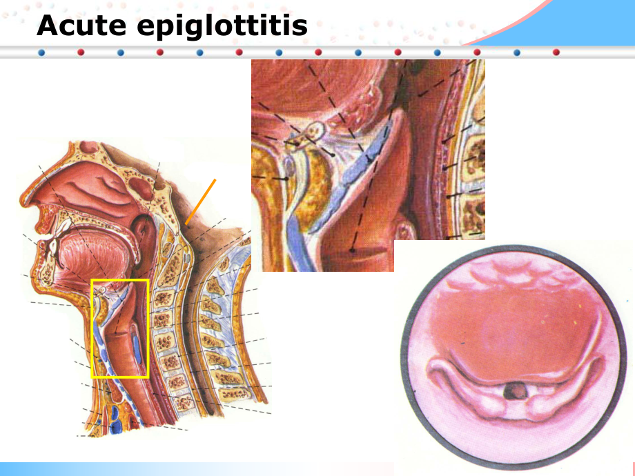 耳鼻喉学课件：急性会厌炎-喉部良恶性肿瘤.ppt_第2页