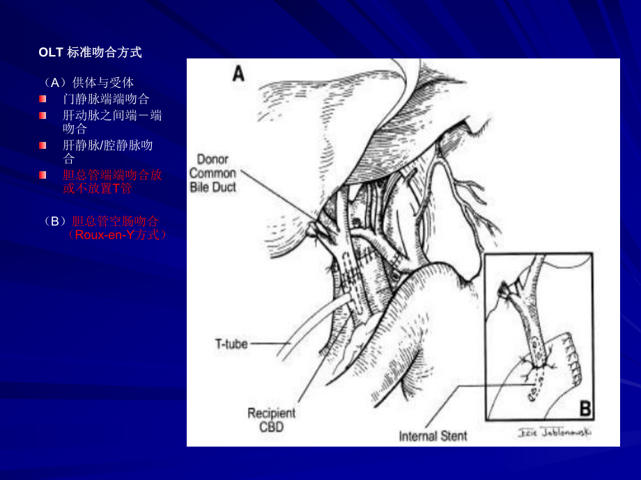 生物医学肝移植后胆道并发症课件.pptx_第1页