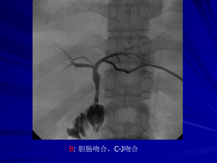 生物医学肝移植后胆道并发症课件.pptx_第3页