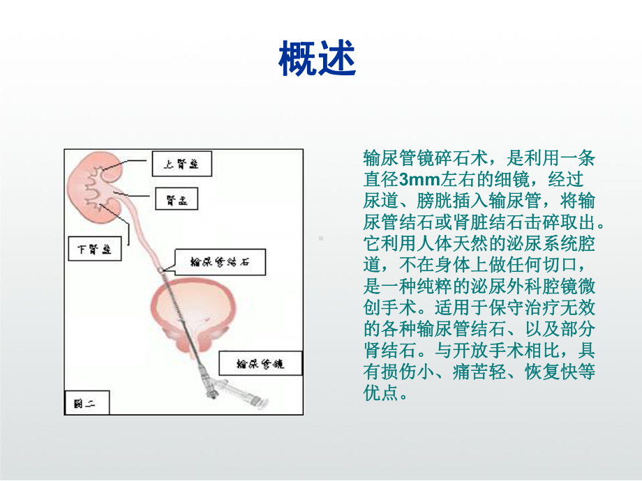 输尿管镜碎石术课件.ppt_第3页