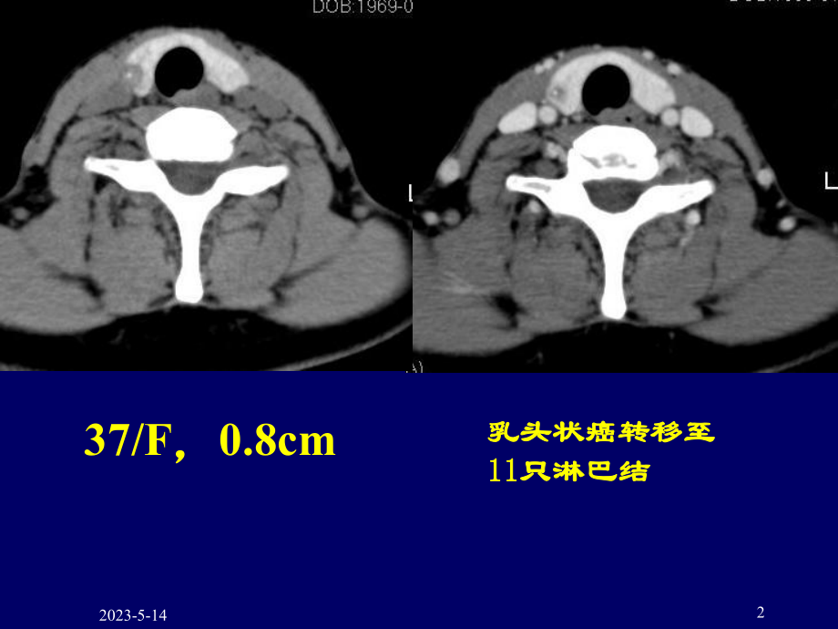 甲状腺结节的ct鉴别诊断课件.ppt_第2页