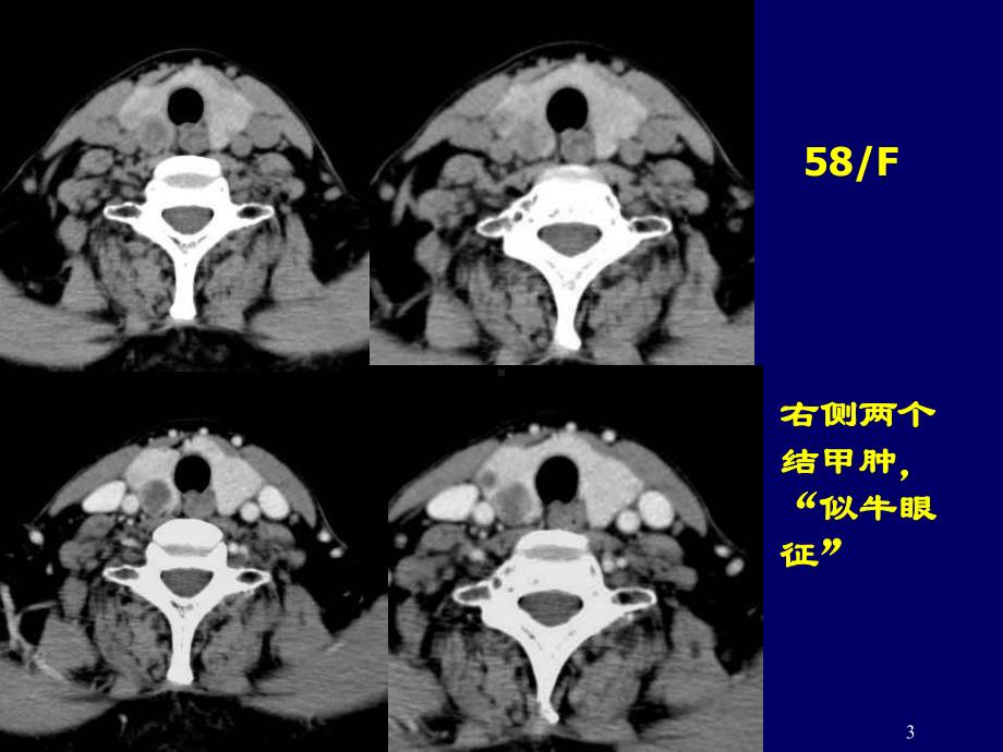 甲状腺结节的ct鉴别诊断课件.ppt_第3页