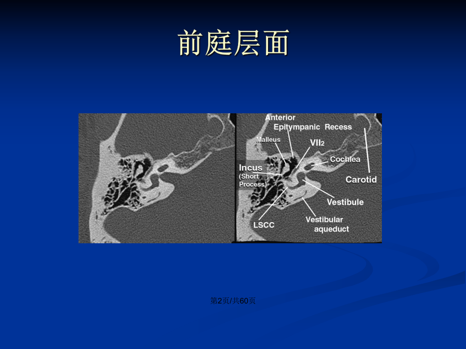 耳畸形影像诊断学习教案课件.pptx_第3页