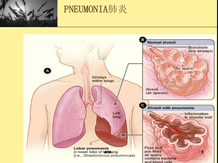 肺炎的护理(带案例)《精选》课件.ppt_第3页