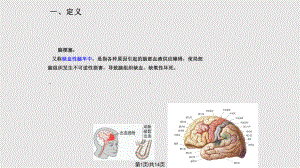 脑梗塞的业务查房课件.pptx