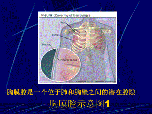 胸膜疾病[课件].pptx