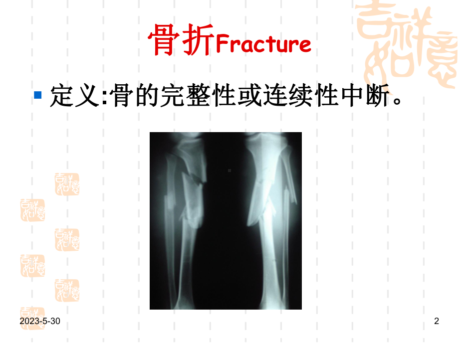 外科学教骨科课件骨折概论.pptx_第2页