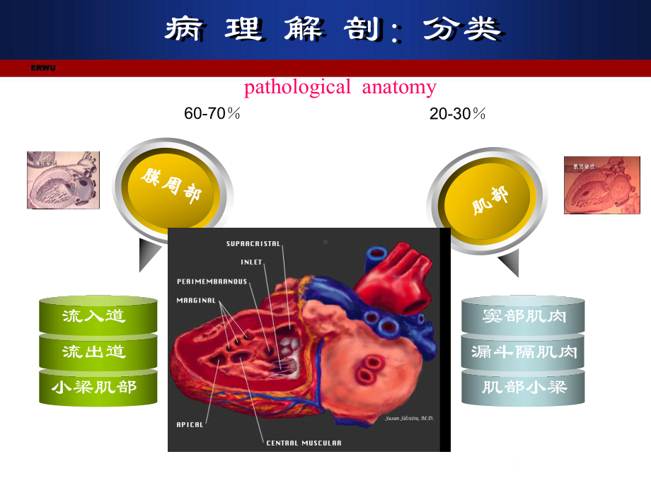 新室隔缺损大学第一医院小儿消化科.pptx_第3页