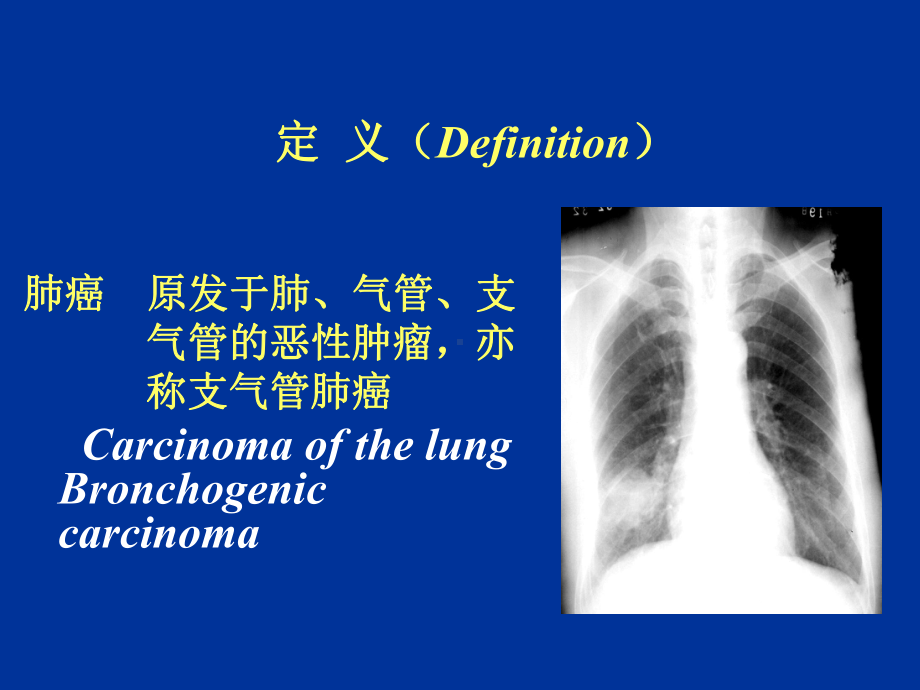 医学课件肺癌10.pptx_第3页