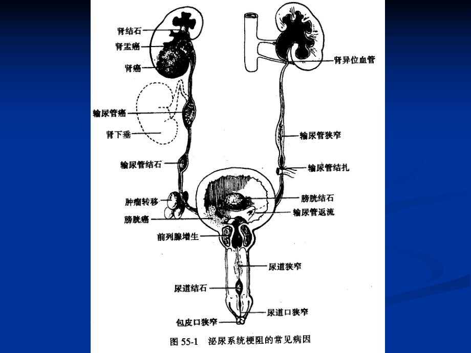 医学教学课件10.18泌尿系梗阻.pptx_第2页