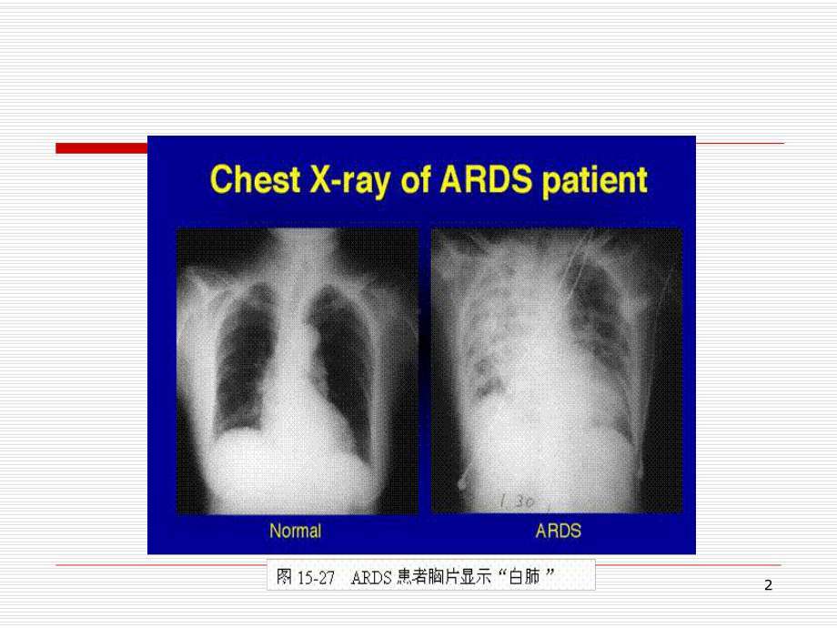 内科学第七版ARDS与MODS课件.ppt_第2页