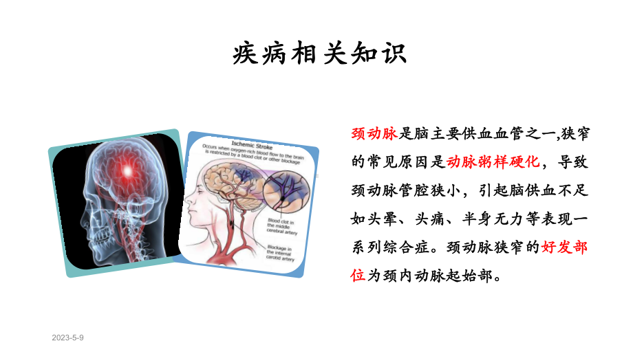 颈动脉支架术后血压管理课件.pptx_第3页