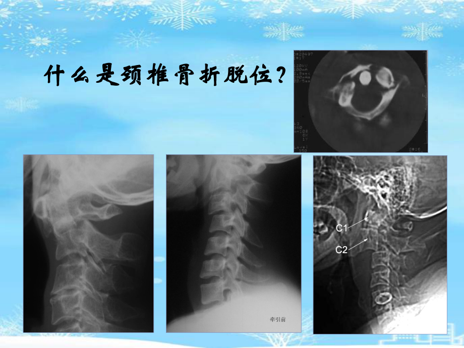 颈椎骨折护理2021完整版课件.ppt_第3页