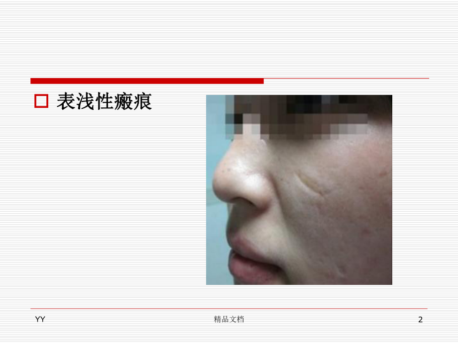 瘢痕疙瘩课件.ppt_第2页