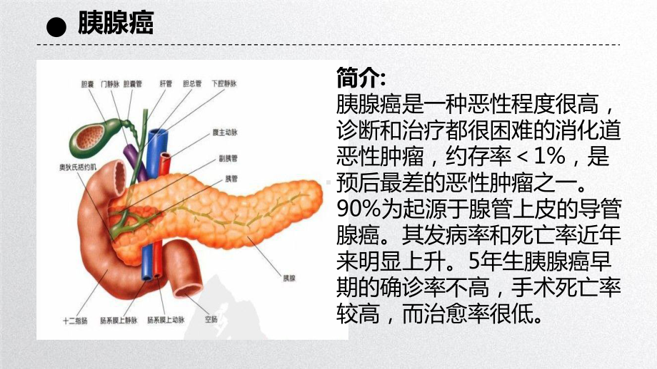 胰腺癌护理查房46877课件.ppt_第2页