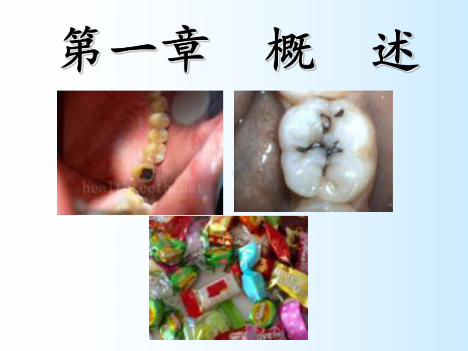 龋病病因、临床表现课件.ppt_第2页