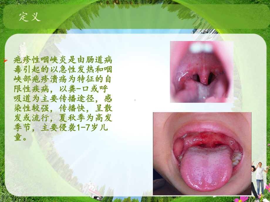 疱疹性咽峡炎课件讲义.ppt_第2页