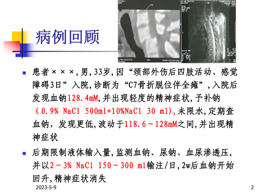 颈脊髓损伤后低钠血症汇总课件.ppt_第2页