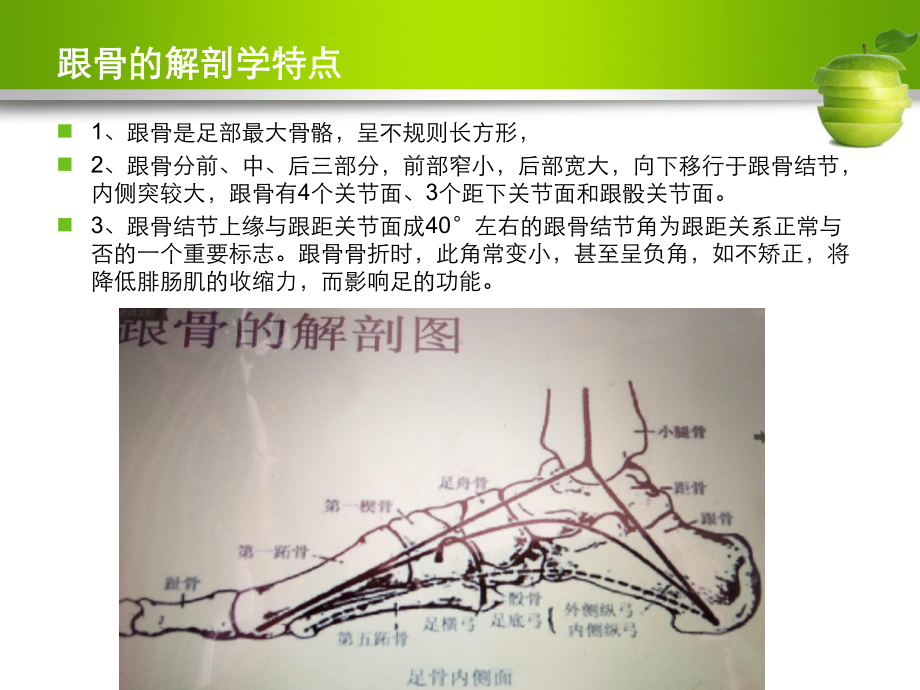 跟骨骨折骨外科护理查房课件.ppt_第3页