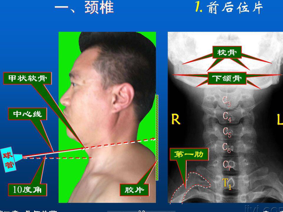 新版颈椎影像解剖学课件.ppt_第3页