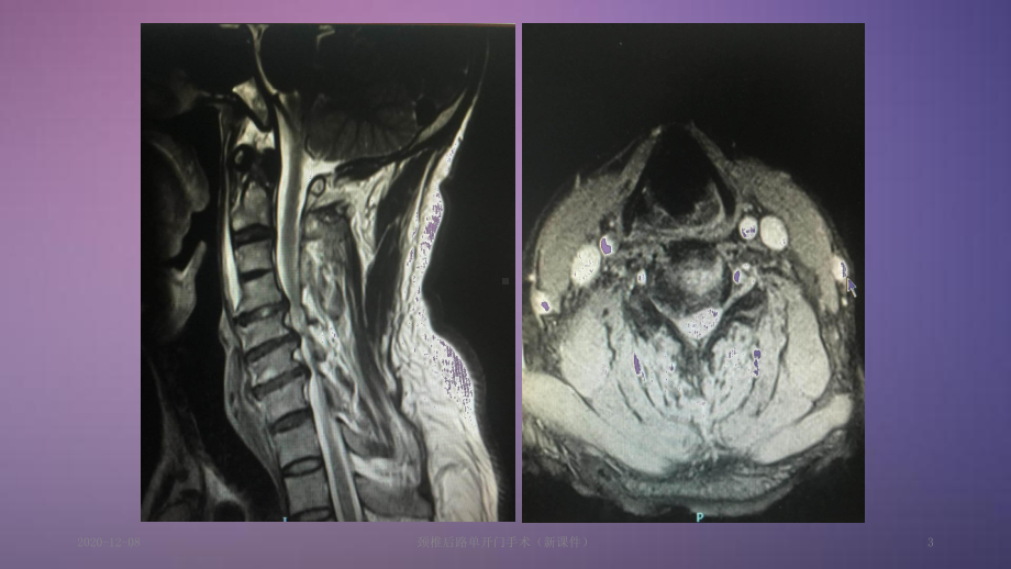 颈椎后路单开门手术(新课件).ppt_第3页