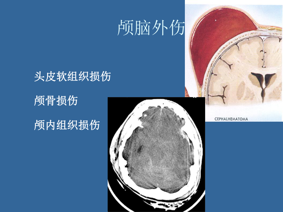 颅脑外伤影像诊断-课件.ppt_第3页